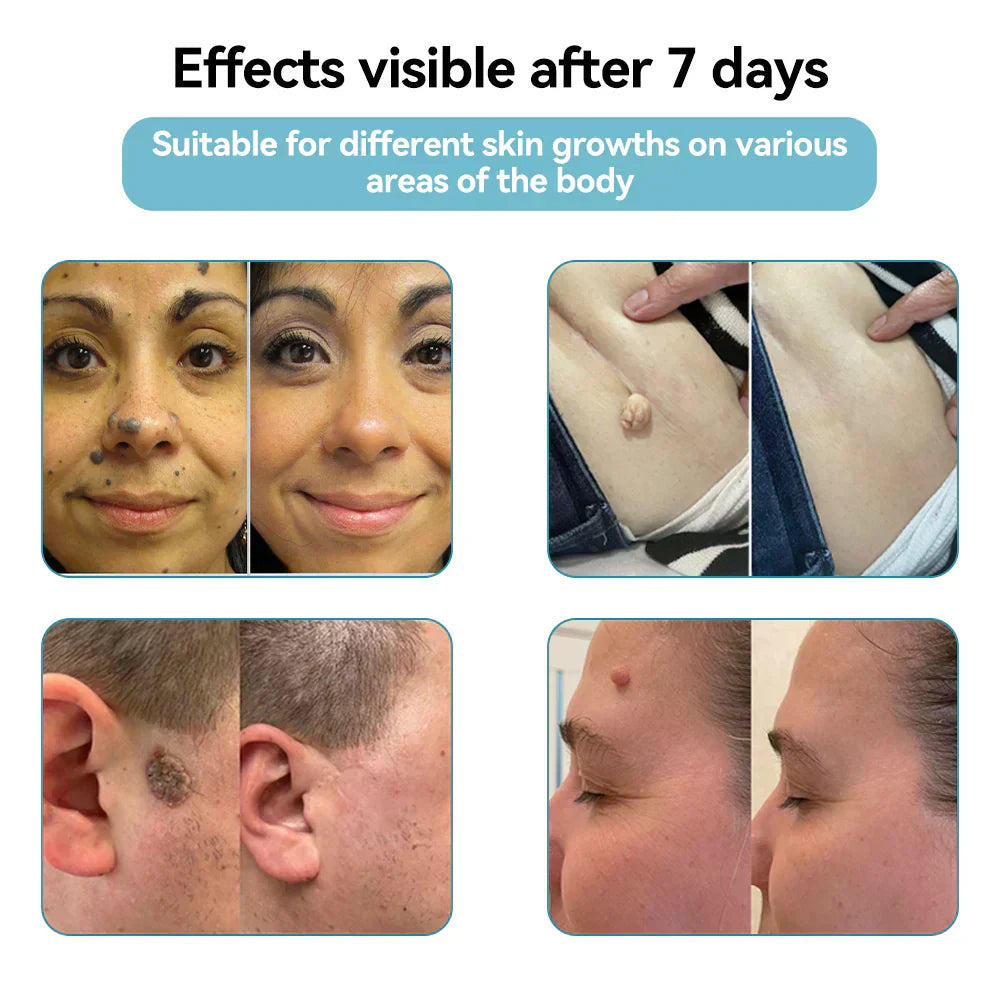 ✨Ptyalial™ All-in-One CO₂ Laser Eraser Pen | Removes Moles, Warts, Skin Flaws & Pigmentation