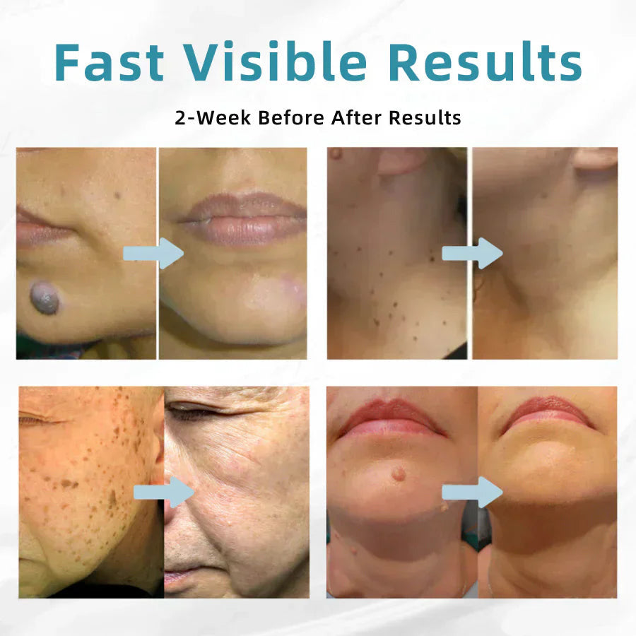✨Ptyalial™ All-in-One CO₂ Laser Eraser Pen | Removes Moles, Warts, Skin Flaws & Pigmentation