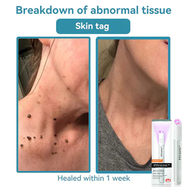 ✨Ptyalial™ All-in-One CO₂ Laser Eraser Pen | Removes Moles, Warts, Skin Flaws & Pigmentation